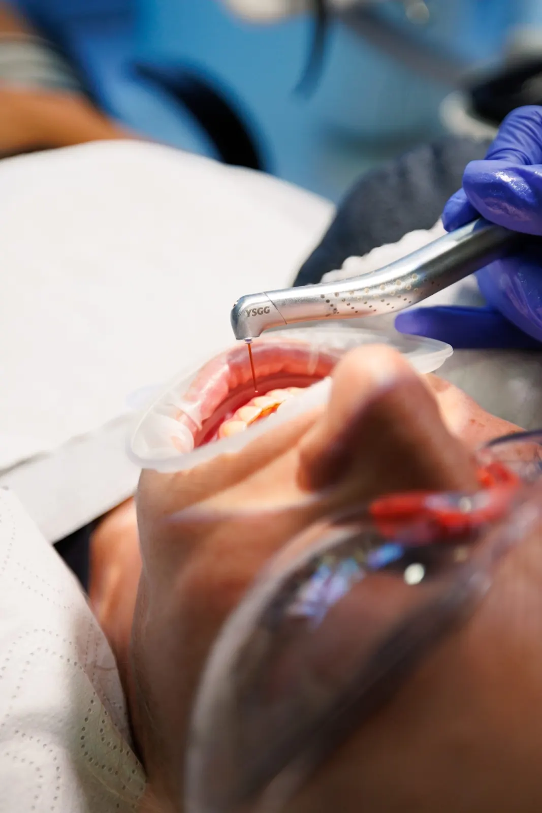 Laser treatment in progress, with the patient wearing protective glasses