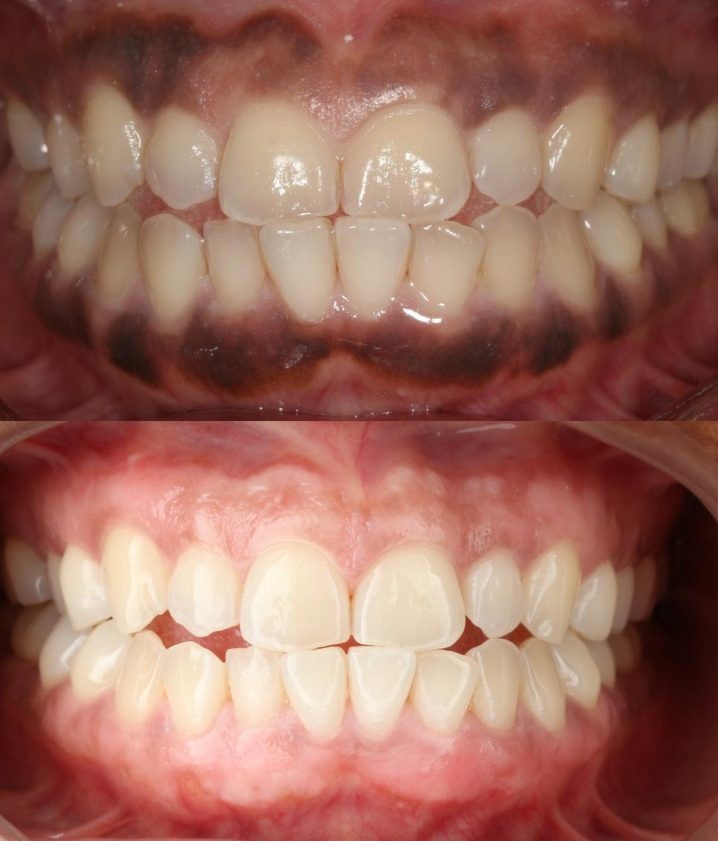 Gum Depigmentation