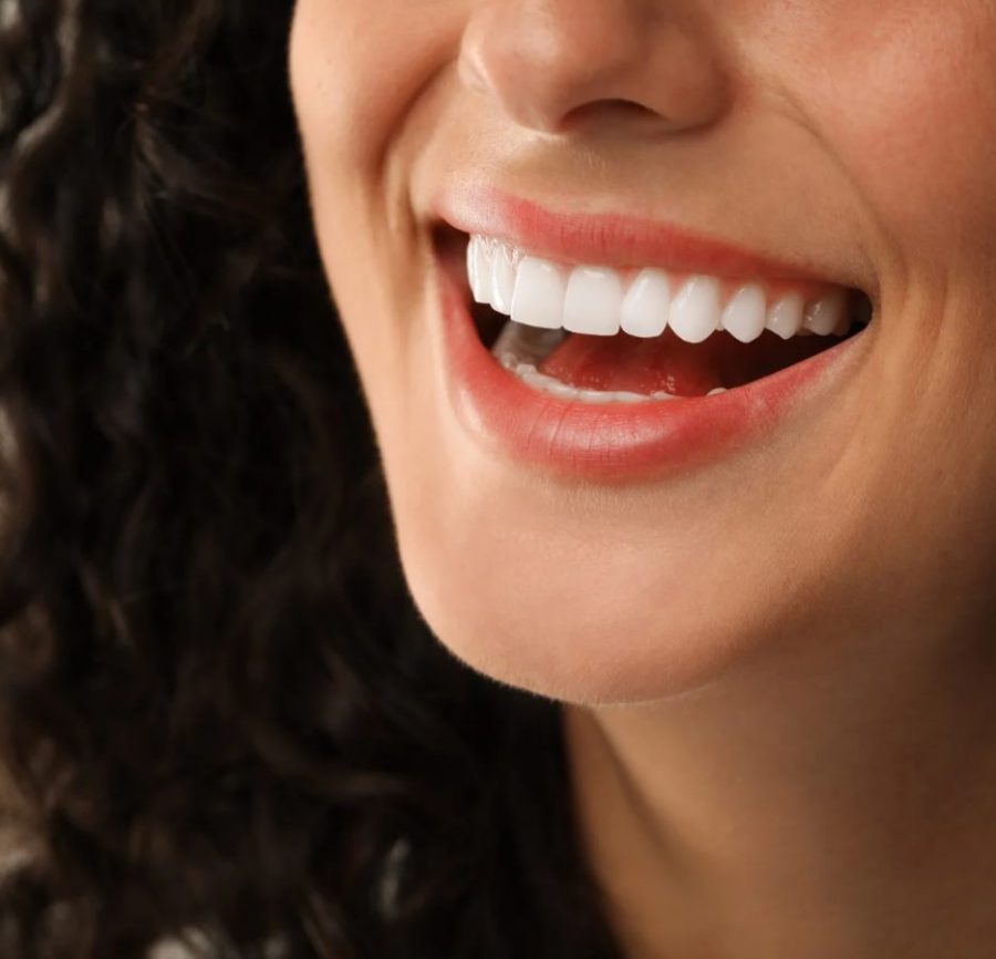 Porcelain Veneers