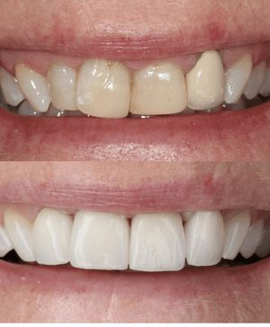 Zoom! Whitening