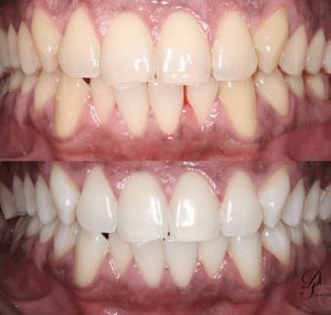 Zoom! Whitening