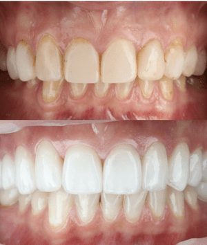 Zoom! Whitening